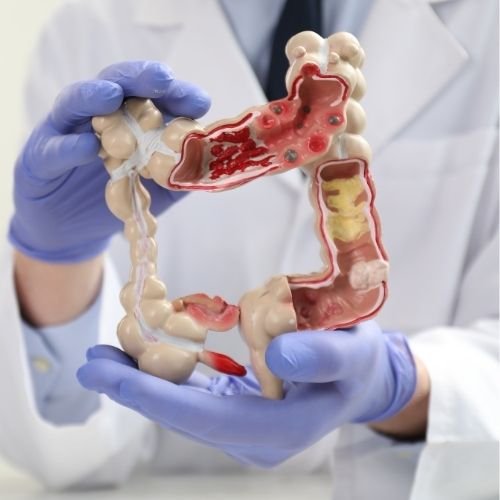 BAĞIRSAK HASTALIKLARI